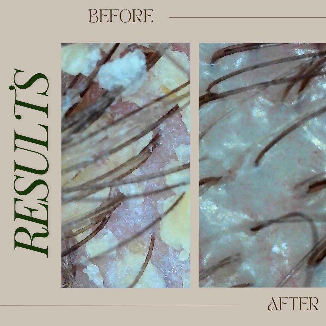 Scalp analysis, before + after, on screen — The Bronze Lily, St. Petersburg, FL