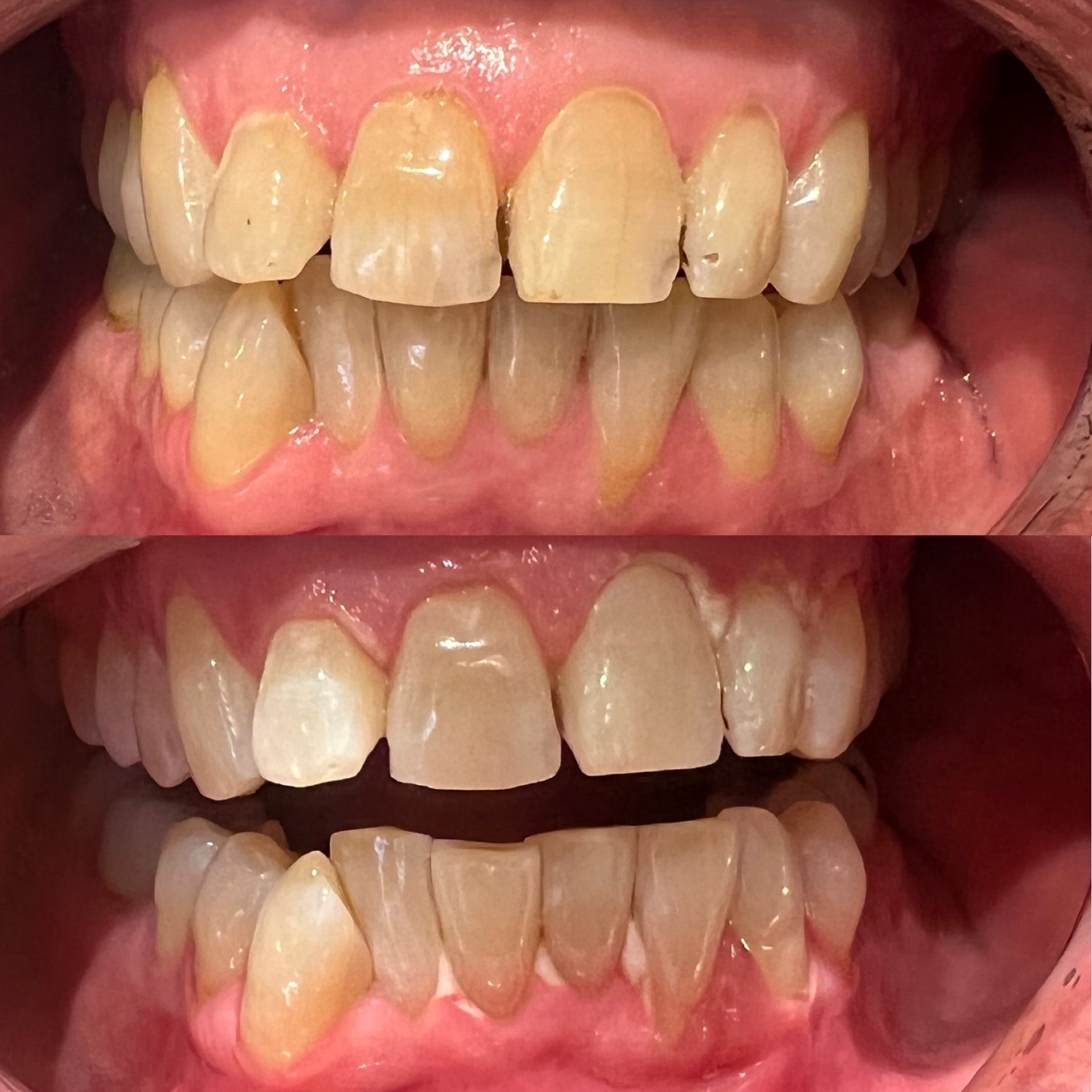 Precision LED teeth whitening session — The Bronze Lily, St. Petersburg, FL