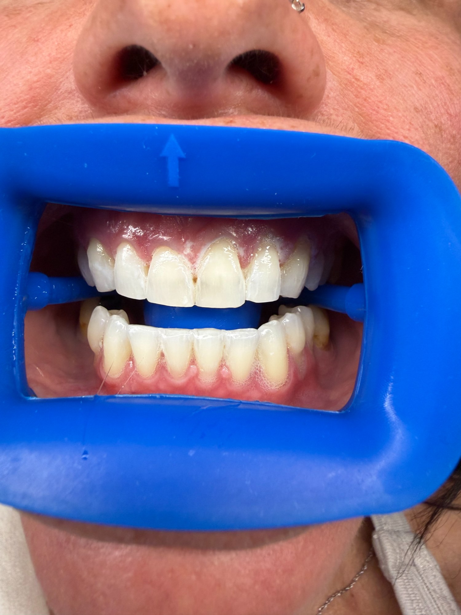 Teeth Whitening gallery photo — The Bronze Lily, St. Petersburg, FL