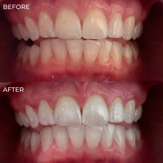 Precision LED teeth whitening session — The Bronze Lily, St. Petersburg, FL