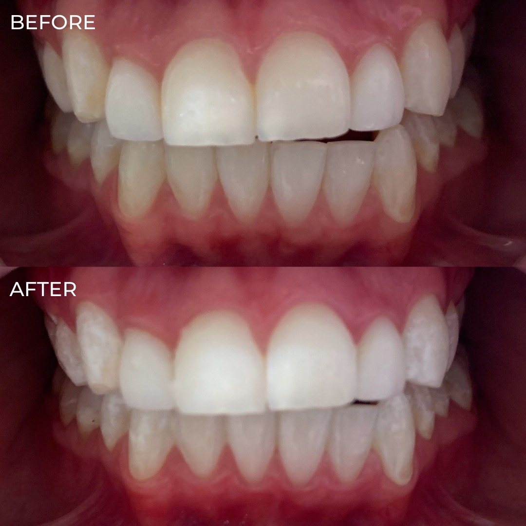 Precision LED teeth whitening session — The Bronze Lily, St. Petersburg, FL