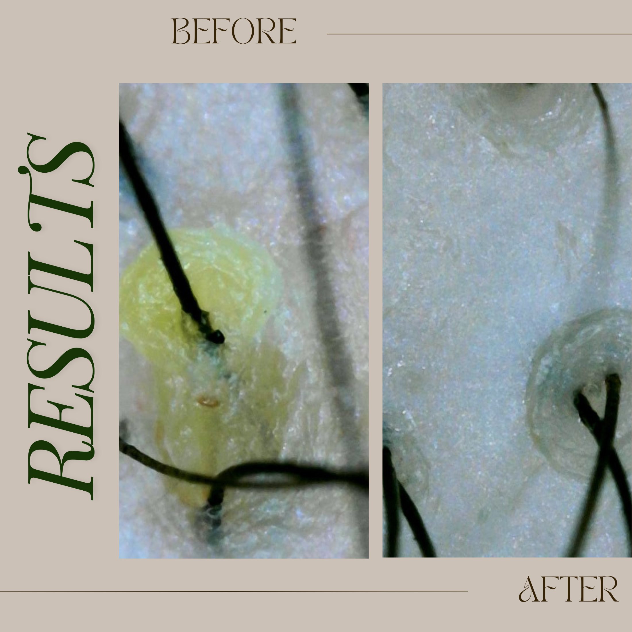 Tricho before & after, buildup + oil balance composite — The Bronze Lily, St. Petersburg, FL