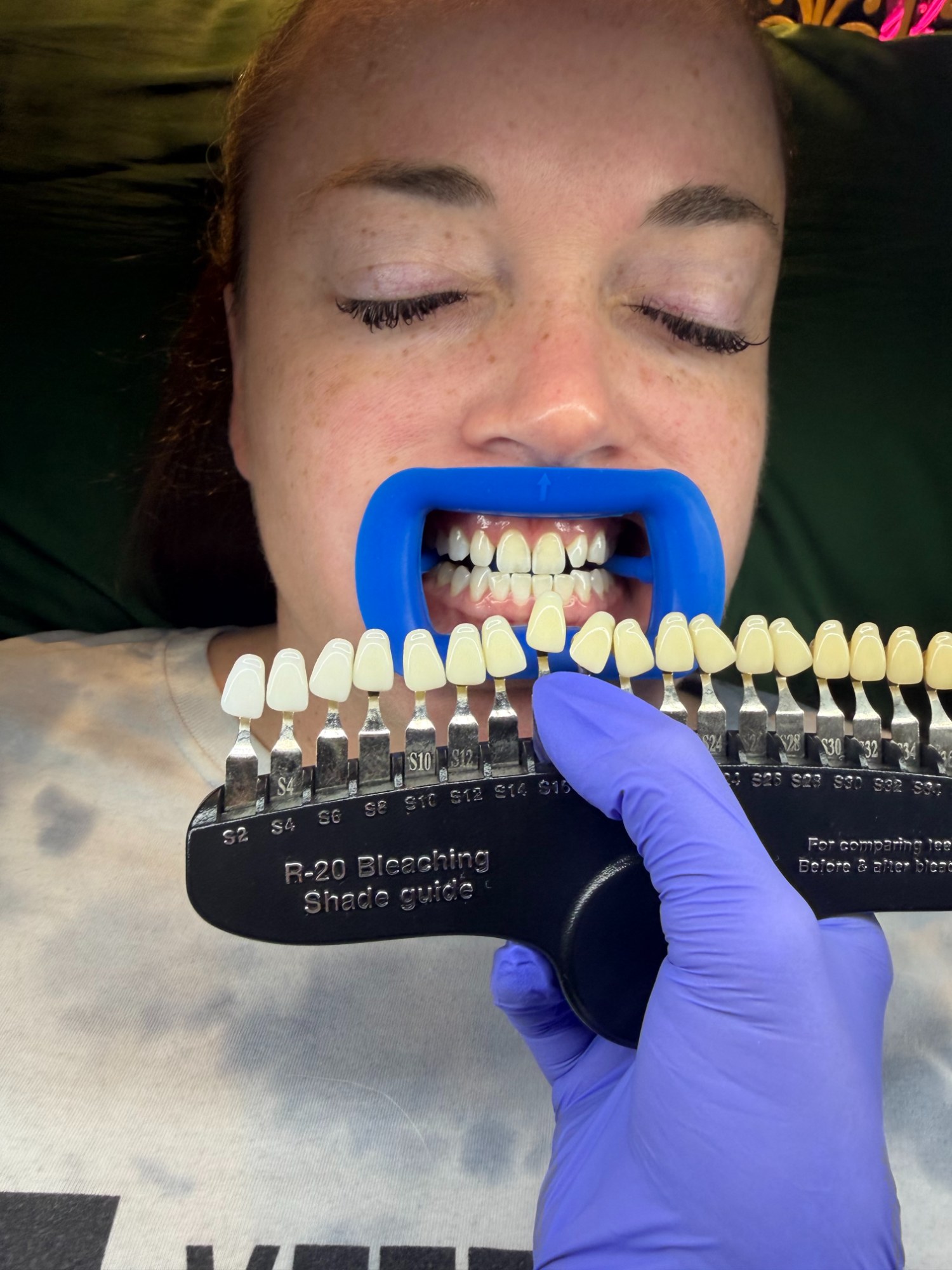 Whitening session, LED treatment in progress — The Bronze Lily, St. Petersburg, FL